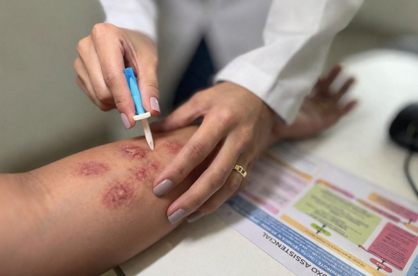 Hospital Ib Gatto Falcão contribui para a detecção precoce e orientação no enfrentamento à hanseníase