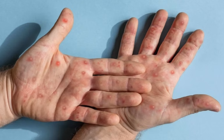 África tem quase 4 mil novos casos de mpox em uma semana, mas ainda não recebeu vacinas