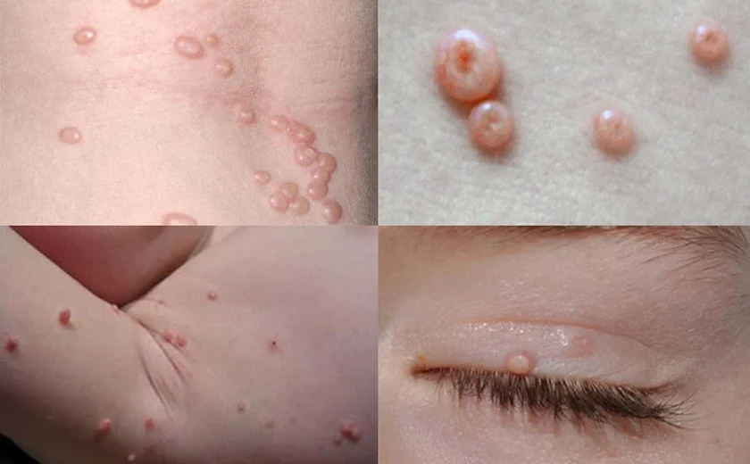 Molusco contagioso: o que você precisa saber