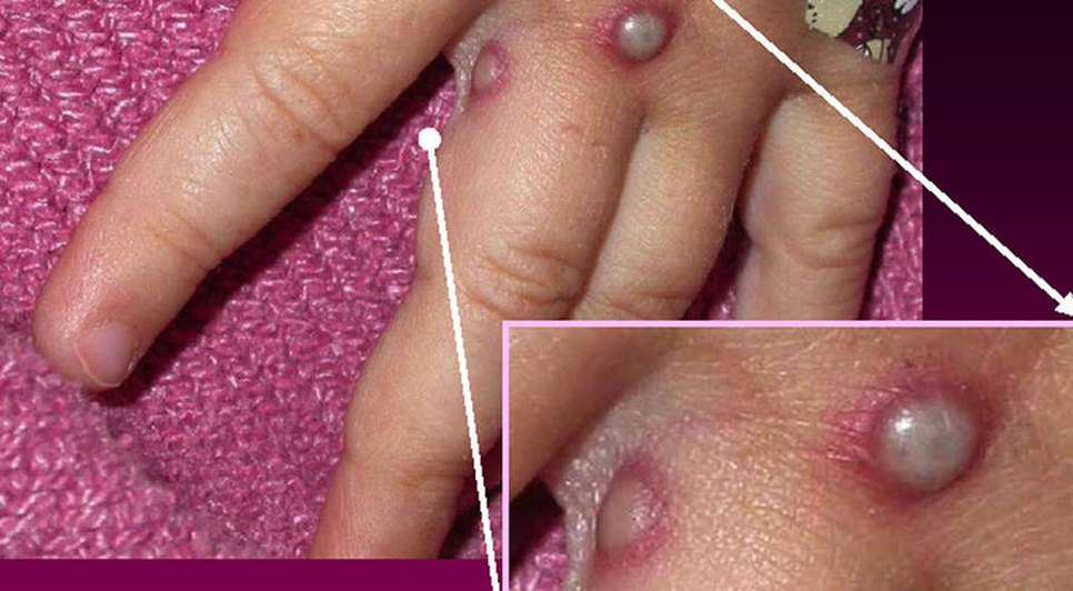 Lesões na pele podem durar até quatro semanas / Foto: Foto: CDC/Divulgação