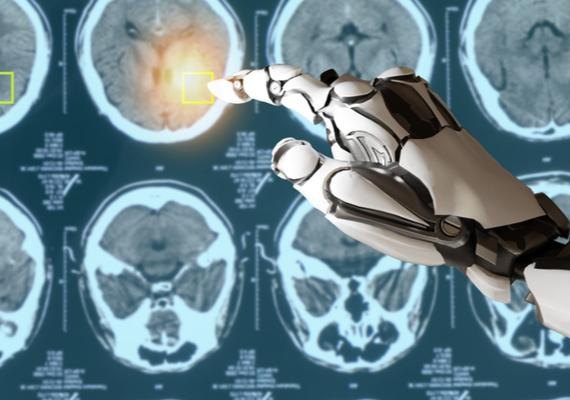 Pesquisa alagoana usa inteligência artificial para prever risco de retorno do câncer