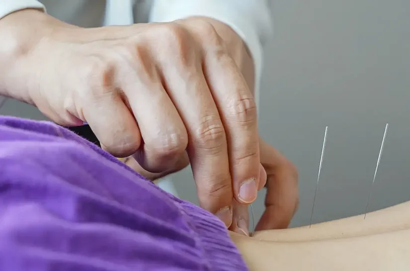 Brasil regulamenta exercício profissional da acupuntura