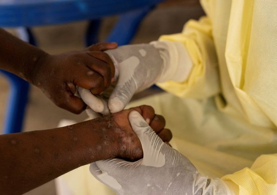 Mpox: conheça sintomas e tire principais dúvidas sobre a doença