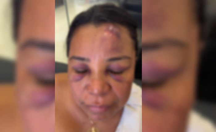 Mulher denuncia ter sido agredida por policiais militares durante festa de São João no Benedito Bentes