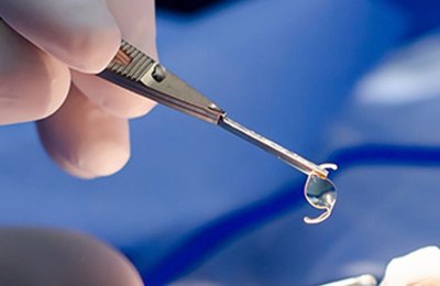 Secretaria de Saúde convoca pacientes que precisam de cirurgia de catarata em Palmeira e região