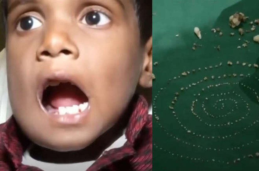 Menino de 7 anos na Índia tem 526 dentes removidos de tumor raro na mandíbula