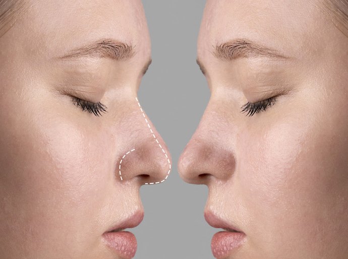 Rinoplastia: estética ou saúde? Entenda quando a cirurgia do nariz é necessária