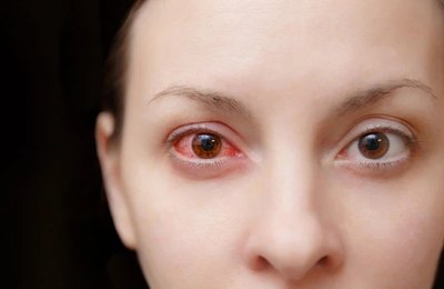Conjuntivite: oftalmologista orienta sobre prevenção e quando buscar atendimento