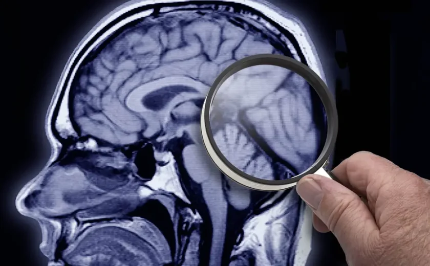Alzheimer: genética pode ser a causa (não apenas fator de risco), revela novo estudo