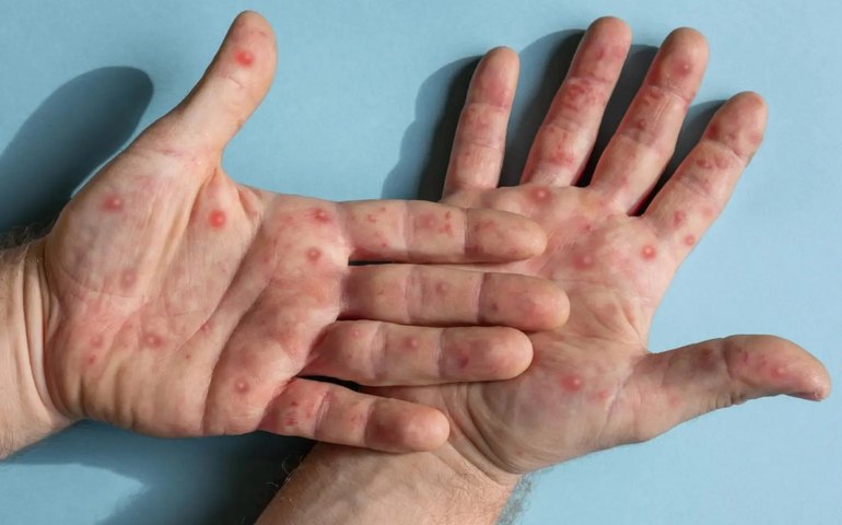 Mpox: Brasil já registrou 709 casos da doença este ano