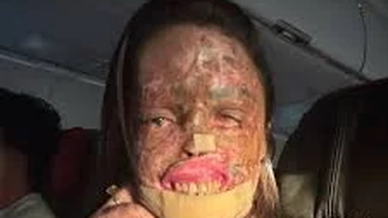 Káh Felipe: entenda o que é xeroderma pigmentoso, doença que afetava a influenciadora