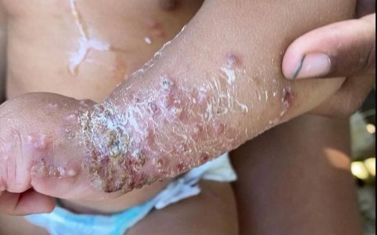 Sarna humana atinge moradores do litoral de SP