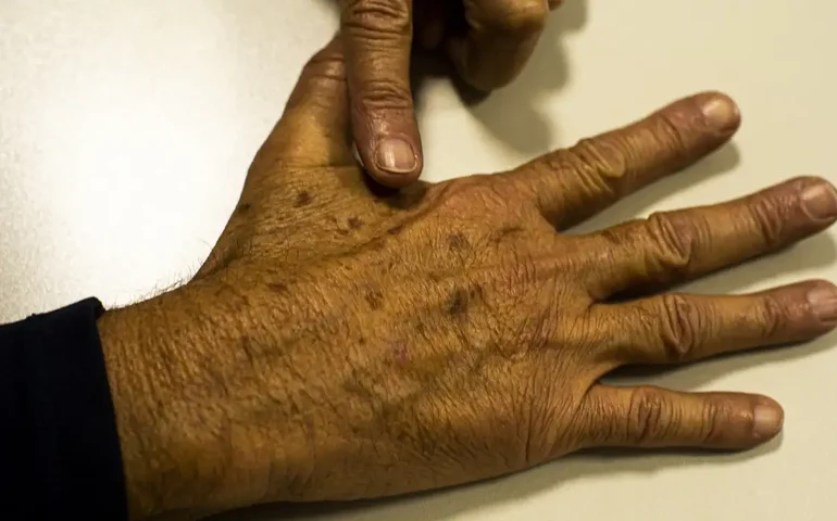 Pesquisadores desenvolvem hidrogel anti-inflamatório de baixo custo