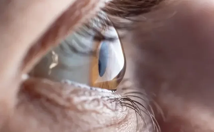 Fila para transplante de córnea dobrou no Brasil. Estudo lista gargalos