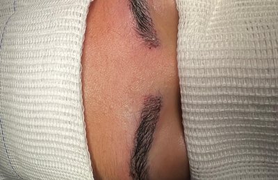 Transplante de sobrancelha: a técnica cirúrgica que virou tendência entre influenciadoras e celebridades