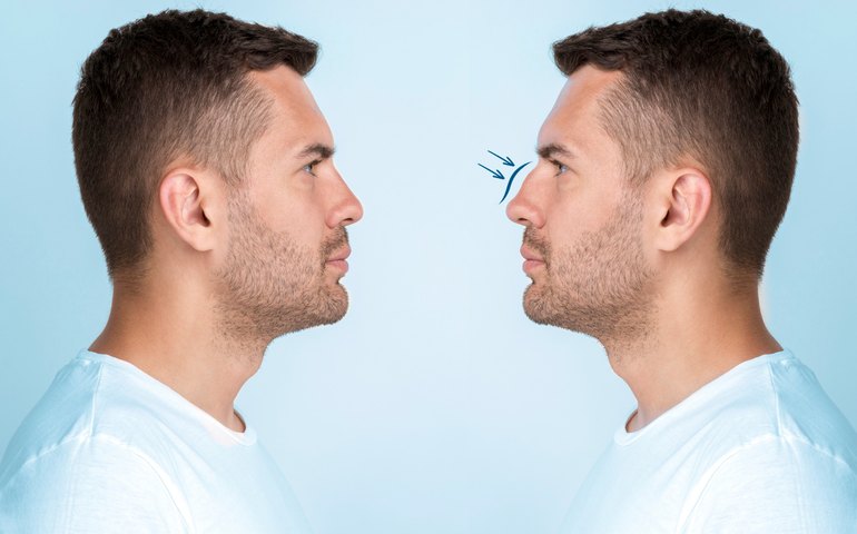 Rinoplastia está entre procedimentos mais buscado por homens