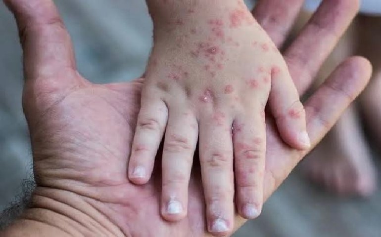 Exame descarta surto da rubéola em crianças de Goiânia