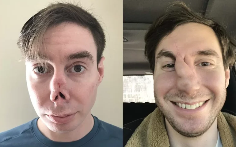 Vídeo mostra como médicos reconstruíram nariz de homem atacado por cachorro, nos EUA