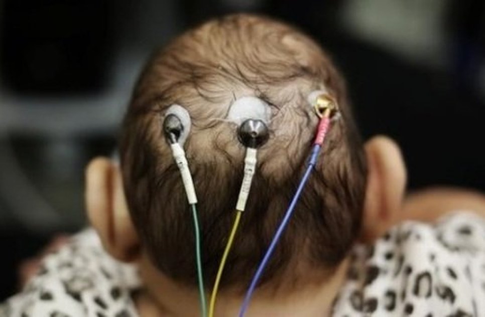 BEBE COM MICROCEFALIA 