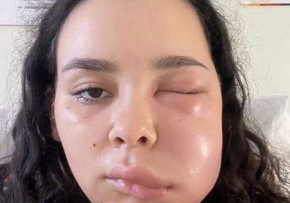 Jovem viraliza ao mostrar evolução de infecção após retirada dos sisos e cita complicações: ‘Traqueia deslocada’