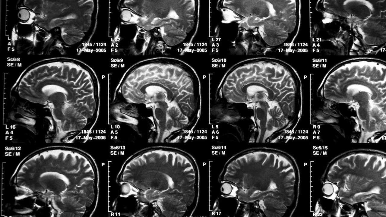 Novo teste de remédio que bloqueia desenvolvimento de Alzheimer tem resultados promissores