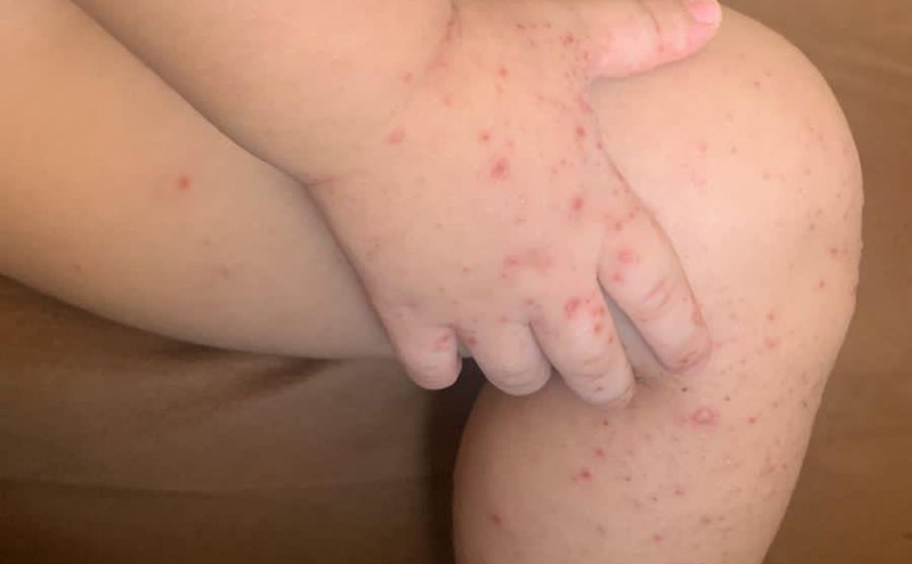 Saúde Maceió orienta sobre os sintomas e formas de prevenção do Vírus Mão-Pé-Boca