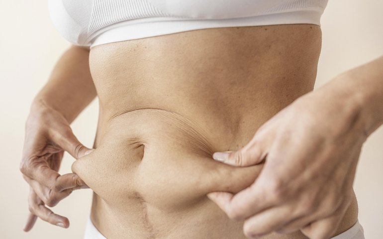 STJ prevê cobertura de cirurgias reparadoras pós-bariátricas