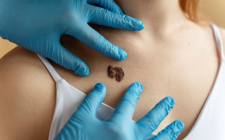 Verão: aumenta o alerta para a prevenção contra o câncer de pele