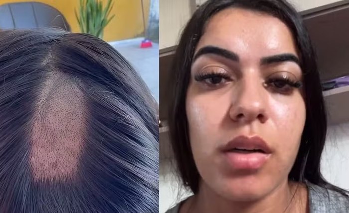 Jovem afirma que laboratório retirou uma quantidade excessiva de fios durante coleta e pede indenização
