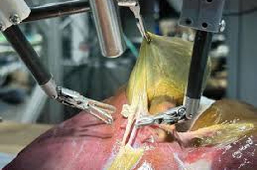 Pela 1ª vez na história, robô faz cirurgia guiado por IA sem qualquer ajuda humana