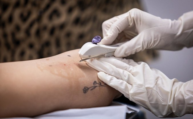 Oferta gratuita do Implanon é avanço histórico na rede pública de saúde de Maceióom Maceió