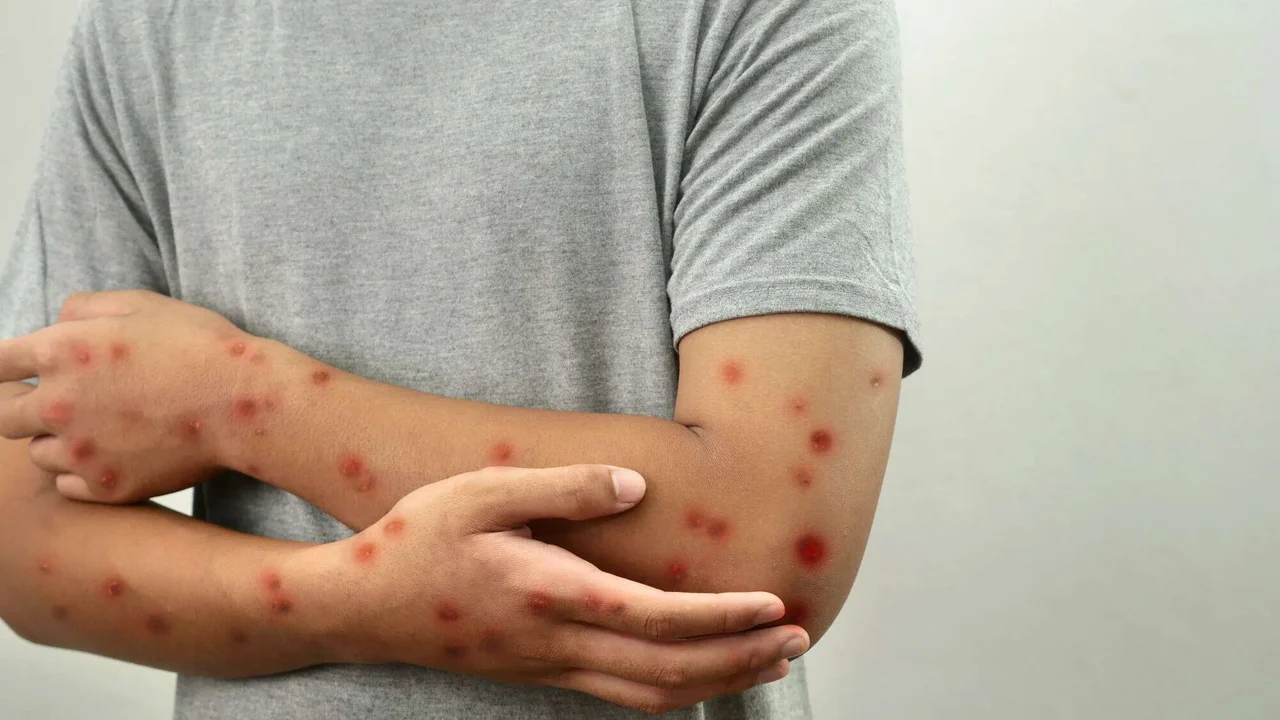 Rio registra alta de casos de Mpox e ex-secretário de saúde faz alerta; saiba como se prevenir