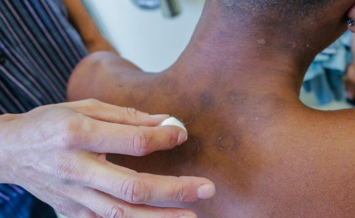 A doença tem cura e o tratamento é gratuito pelo SUS A doença tem cura e o tratamento é gratuito pelo SUS