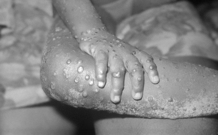 Quatro casos suspeitos de Monkeypox são descartados em Alagoas