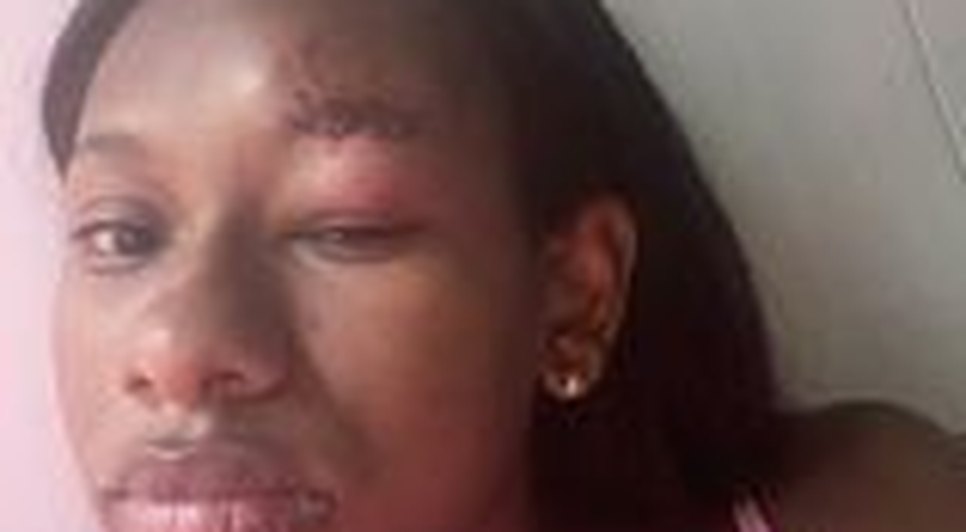 Estudante é acusada injustamente e agredida com mordidas no rosto em Carmópolis