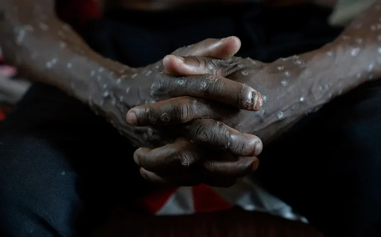 Congo afirma que seu surto de mpox terminou após 2 anos e mais de 2.200 mortes suspeitas