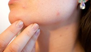 acne-1606765_1280.jpg / Foto: EBC