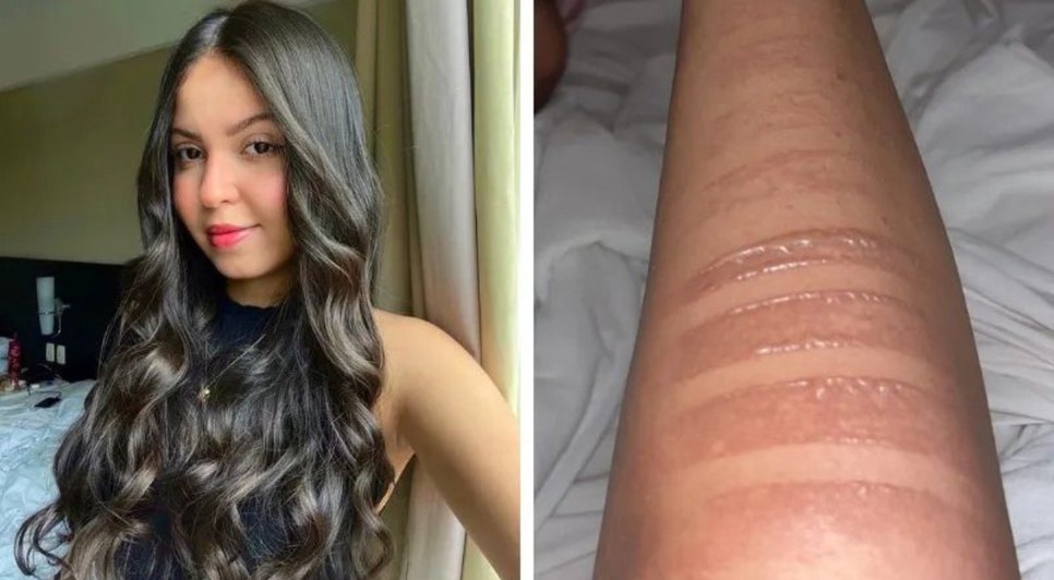 Sergipana sofre queimaduras de segundo grau após adiamento de show da Taylor Swift no Rio de Janeiro