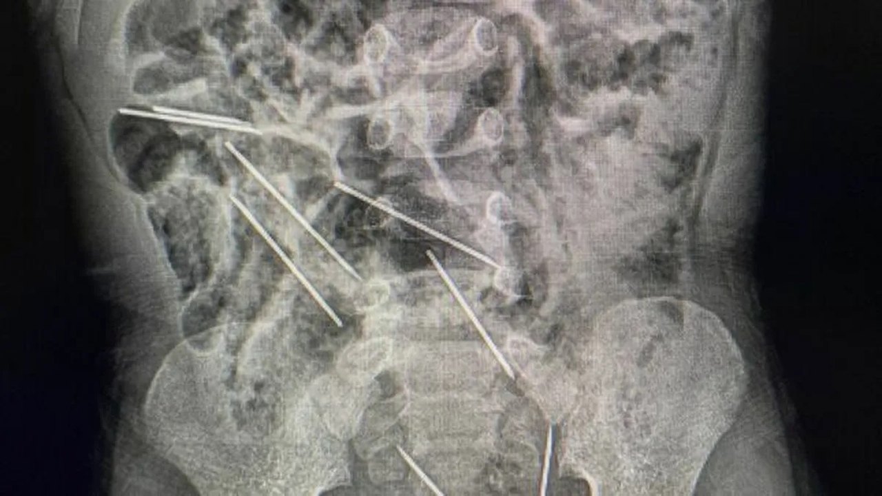 Criança de 2 anos é submetida a cirurgia após engolir oito agulhas no Peru