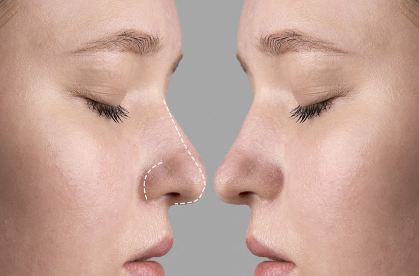 Rinoplastia: estética ou saúde? Entenda quando a cirurgia do nariz é necessária