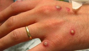 variola-macaco-monkeypox-20052022150612452