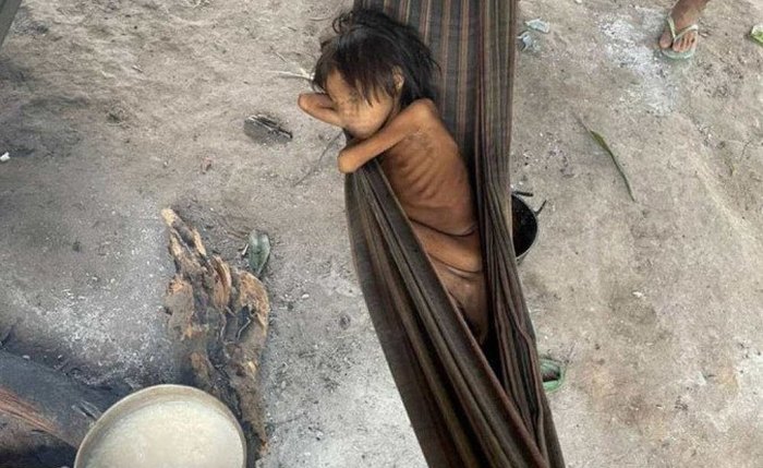 Crise sanitária resultou na morte de 570 crianças por desnutrição e causas evitáveis