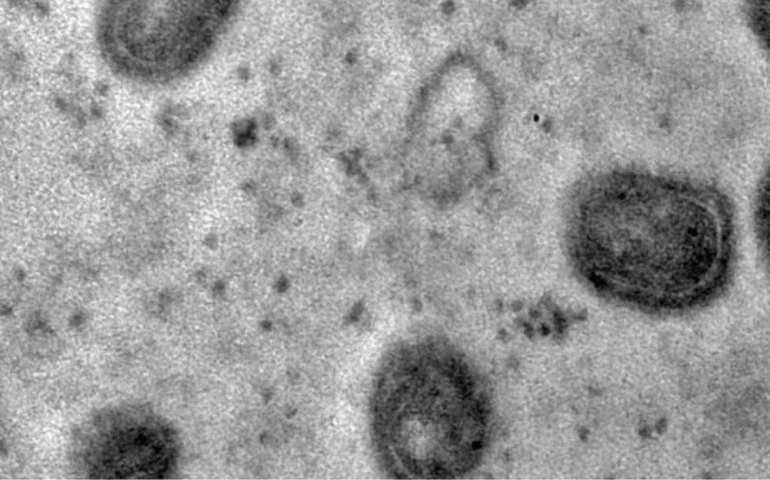 Vacina com RNA mensageiro da Moderna mostra resultados promissores contra mpox