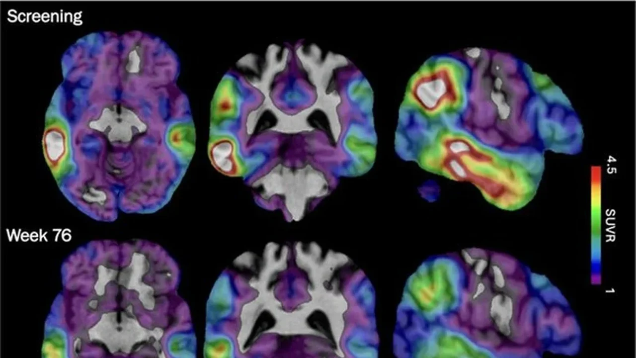 Medicamento experimental para Alzheimer mostra-se promissor enquanto pesquisadores buscam novas abordagens.