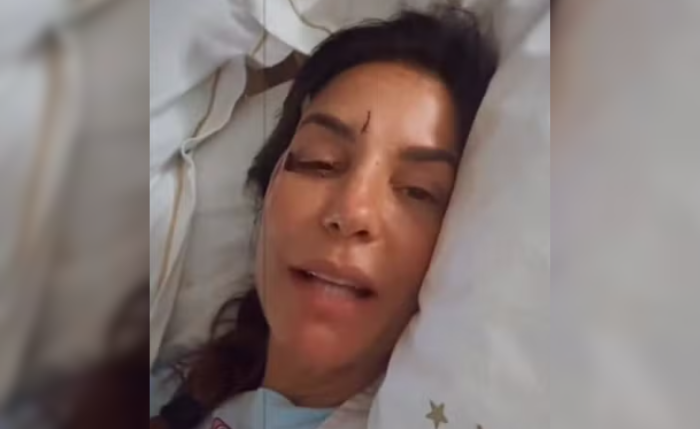 Ivete Sangalo surge com olho roxo após desmaiar