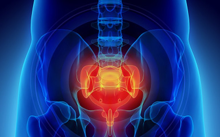 Cirurgia a laser é nova opção para tratar cisto pilonidal