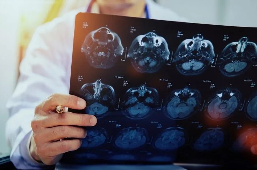 Casos de AVC aumentam no país e reforçam alerta sobre prevenção e monitoramento da saúde