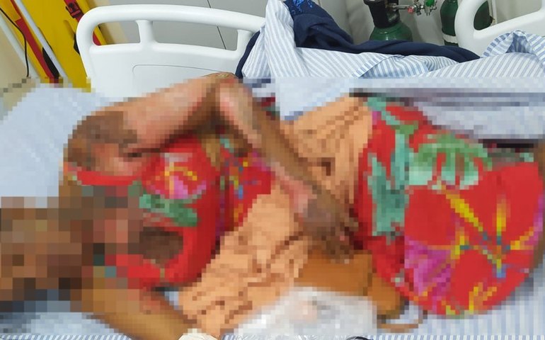 Morre no HGE mulher que teve 70% do corpo queimado em Maceió