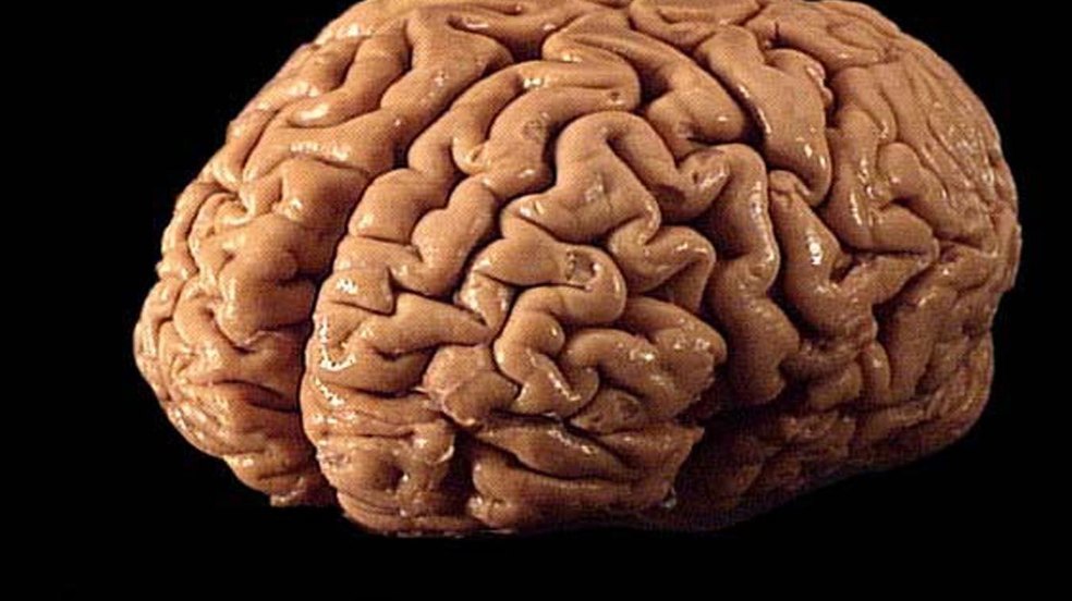 Mulher morre na Sérvia após sofrer rompimento de aneurisma cerebral durante orgasmo