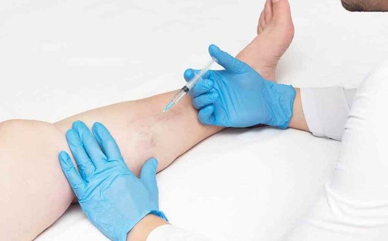 Saúde disponibiliza tratamento de microvasos e varizes no Pam Salgadinho